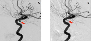 Artériographie cérébrale montrant un anévrisme artériel de l’artère carotide interne (A) et sa guérison après embolisation (B)
