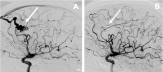 Artériographie montrant une communication directe entre artère et veine (sans interposition d’un lit capillaire) (A) et sa guérison après embolisation de la malformation (B)