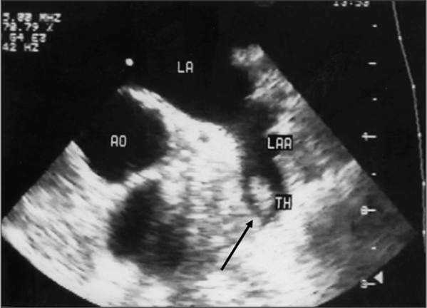 Échographie cardiaque montrant un thrombus (TH) dansl’oreillette gauche chez un patient ayant une fibrillation atriale (trouble du rythme cardiaque favorisant la formation d’un thrombus)