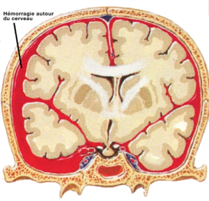 Hémorragie méningée