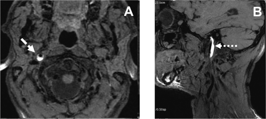Imagerie par résonance magnétique nucléaire (IRM) montant un hématome (en blanc) dans la paroi de
l’artère carotide interne.  A: coupe transversale au niveau du cou. B. coupe sagittale au niveau du cou