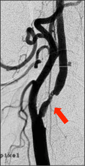 Rétrécissement de l’origine de l’artère carotide interne par une plaque d’athérosclérose (flèche)