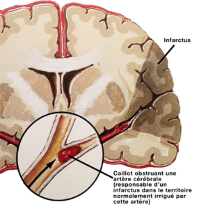 Infarctus cérébral      